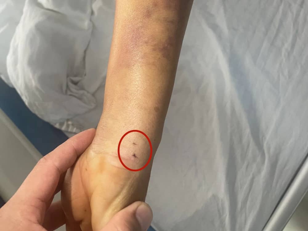 被蛇咬傷怎么辦？ 福德醫(yī)院教你毒蛇咬傷急救指南